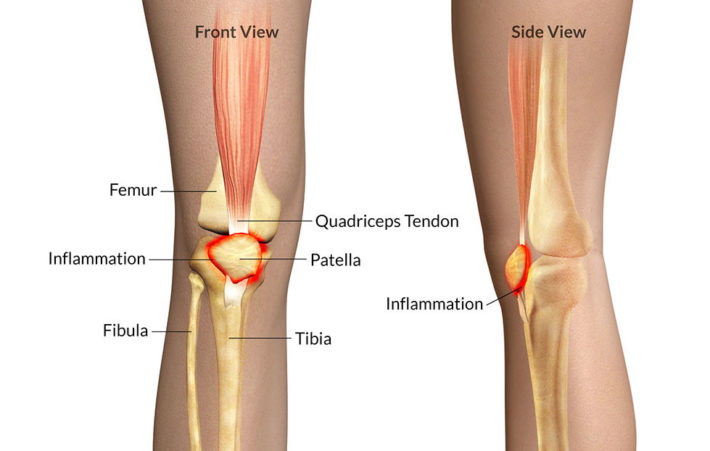 Running Injuries: Mechanism And Intervention 