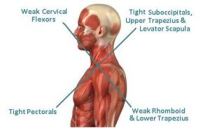 upper cross syndrome symmetry physical therapy