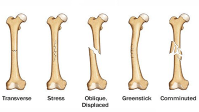 Bone fracture