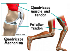 Quadriceps tightness