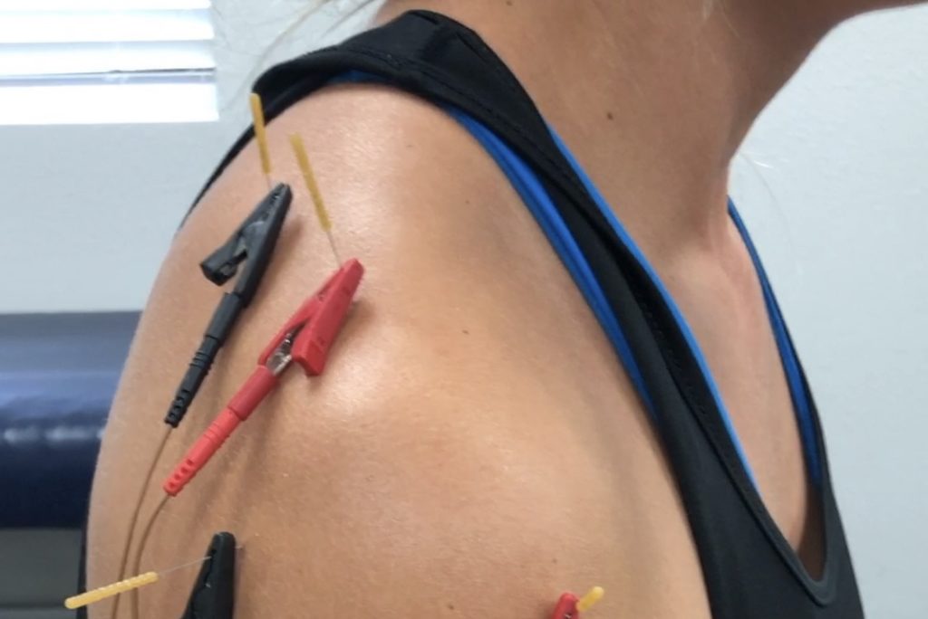 Dry needling in downtown Miami, Florida.