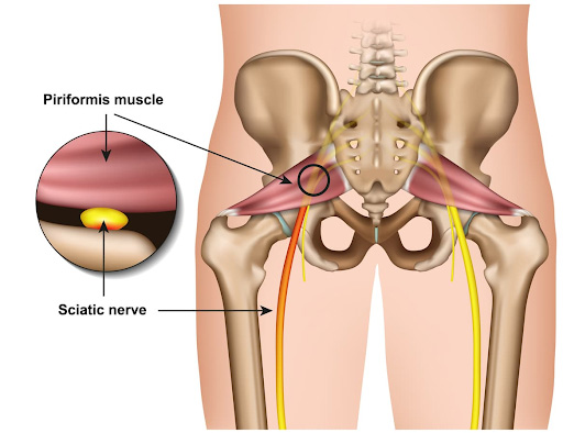 Piriformis syndrome hip pain symmetry pt miami
