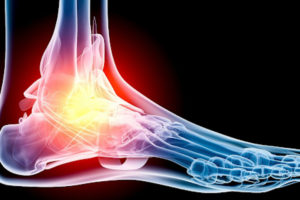 Physical therapy for foot pain symmetry pt miami