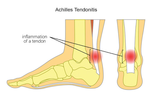 Achilles tendonitis symmetry pt miami