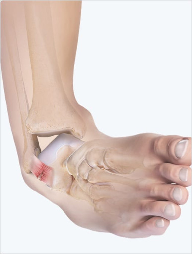 Physical therapy for ankle instability and foot pain symmetry pt miami