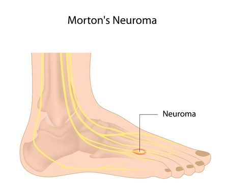 Mortons Neuroma and toe pain symmetry pt miami