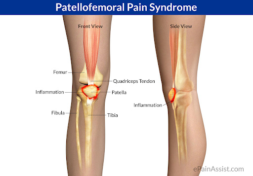 What is Patellofemoral Pain Syndrome?
