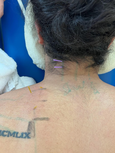 dry needling neck symmetry physical therapy miami
