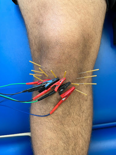 dry needling knee symmetry pt miami