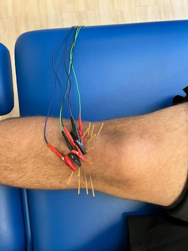 Dry needling for knee pain, jumper's knee, and patellar tendonitis