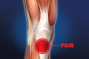 Dry needling for knee pain, jumper's knee, and patellar tendonitis