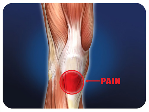 Dry needling for knee pain