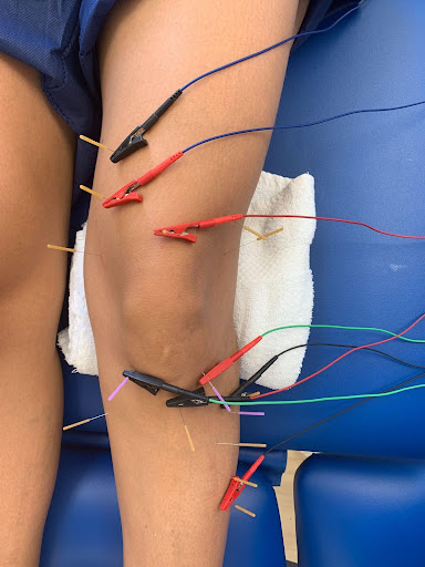 Dry needling on knee symmetry pt miami