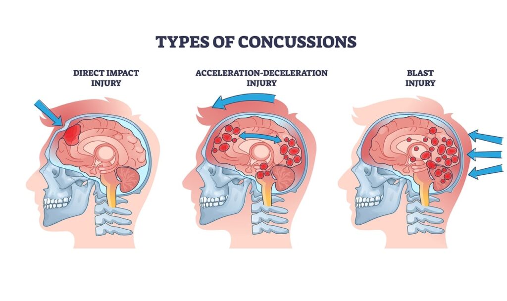 types_of_concussions_tile - Symmetry Physical Therapy