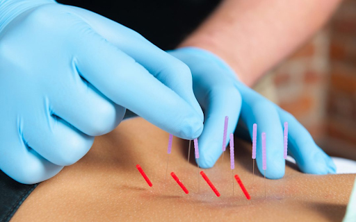 Dry Needling for Chronic Pain