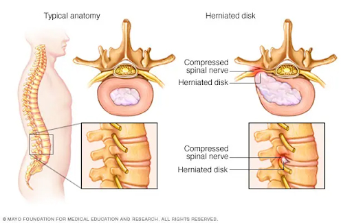 Herniated Disc Diagram