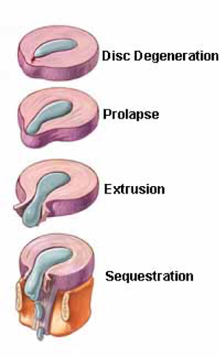 Herniated Discs