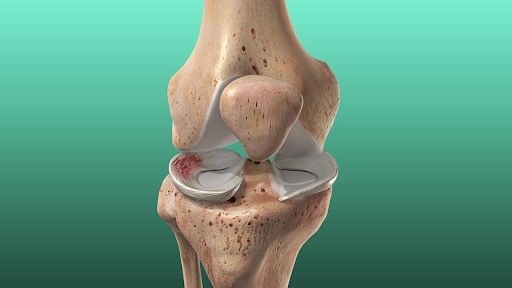 Meniscus Injuries and Physical Therapy