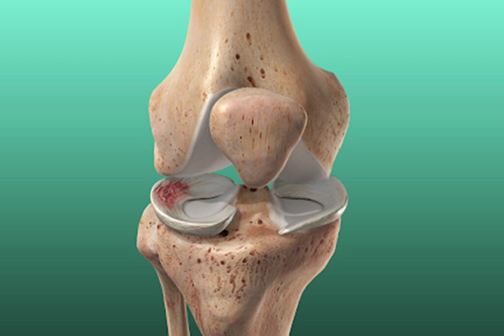 Meniscus Injuries and Physical Therapy