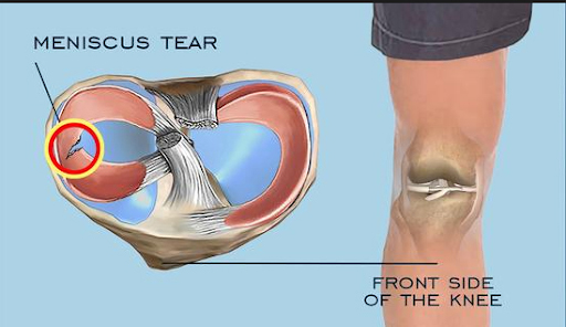 Meniscus Tear