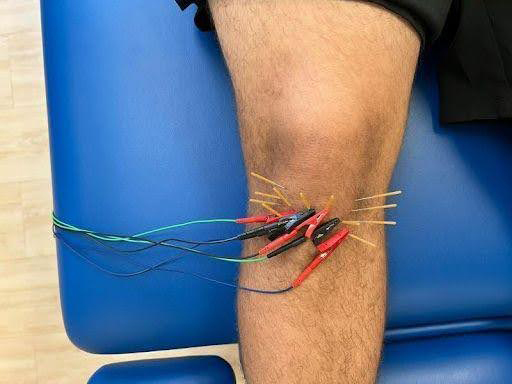 Dry Needling