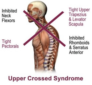 Upper Crossed Syndrome