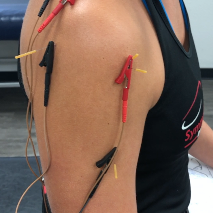 dry needling shoulder